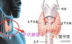 甲状腺专家赵萍：脖子发现这2种异常，要警惕