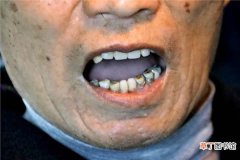 中年牙齿松动是拔还是不拔，中医上医治未病通常是这3个等级