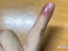 重庆女子拔倒刺手指肿一周，上网一查吓得重视：不是化脓就是截肢