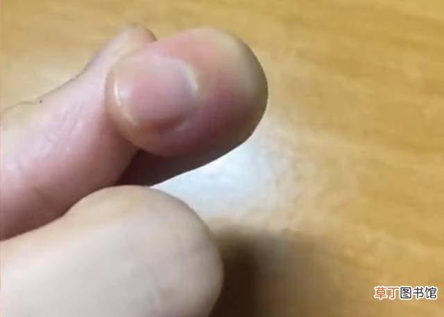 重庆女子拔倒刺手指肿一周 ， 上网一查吓得重视：不是化脓就是截肢