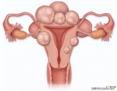 子宫囊肿带给女性的伤害有多大，应该如何治疗？