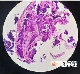 潍坊市人民医院消化内科二区经口胆道子镜诊断罕见病一例