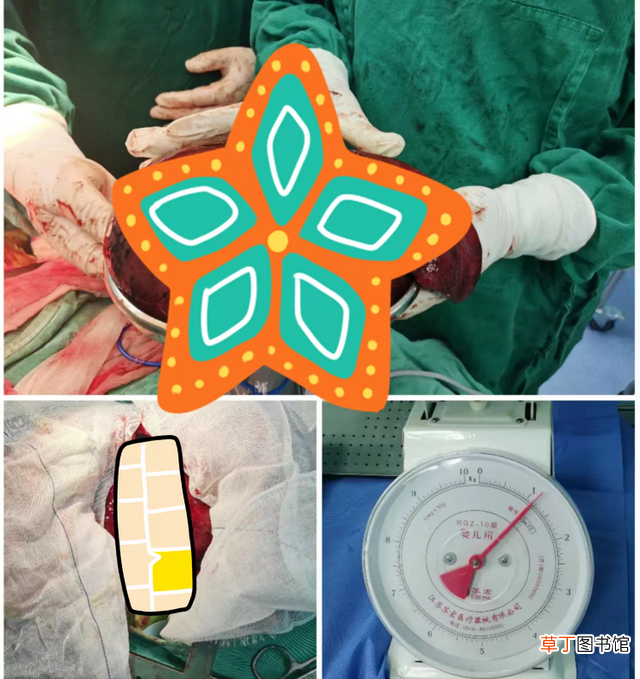 1公斤肿瘤！潍坊市第二人民医院胸外一科成功完成高难度左肺上叶巨大肿瘤切除术