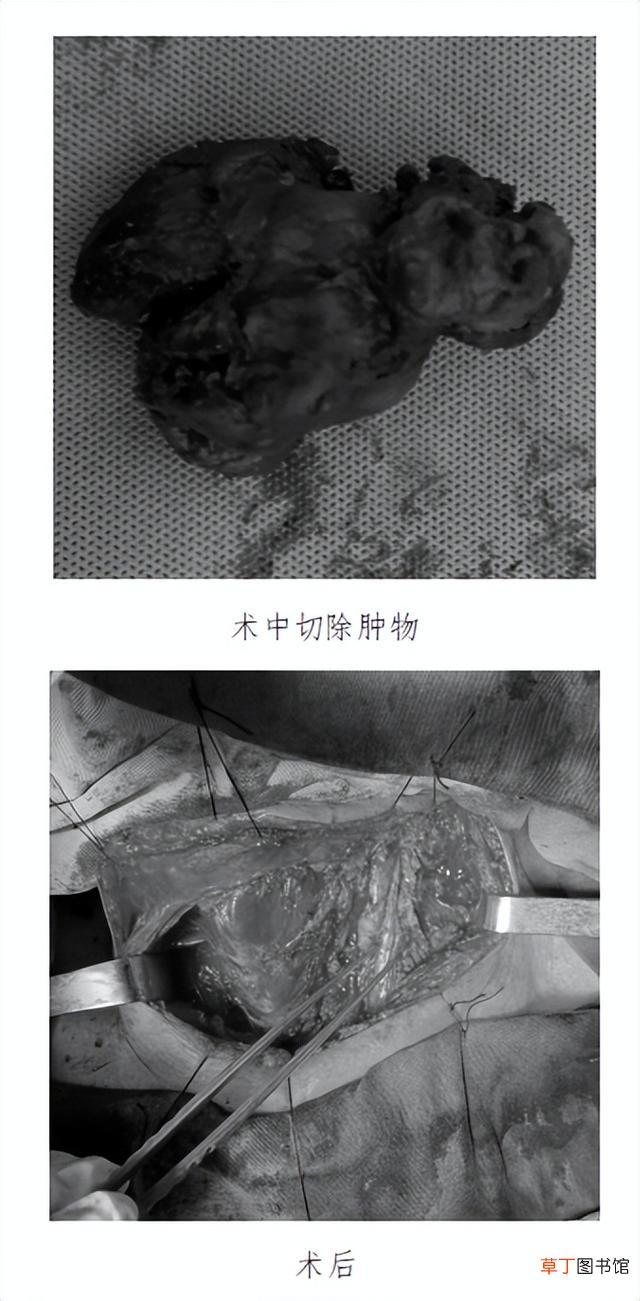 潍坊市第二人民医院普外科成功为八旬老人实施巨大甲状腺癌根治术