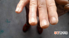 【治疗】怎样识别灰指甲?灰指甲各个阶段图片