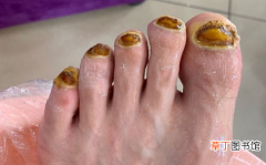 【灰指甲】修脚店灰指甲治疗一半不治了?修脚店治疗灰指甲套路
