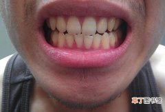 牙齿发黄是什么原因