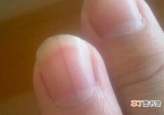 指甲长有黑色竖纹是怎么回事