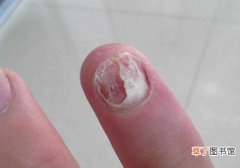 指甲脱落是什么原因