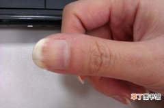 指甲上有竖纹是怎么回事 指甲有竖纹怎么办