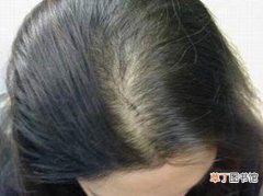 脱发有哪些原因 脱发的常见原因