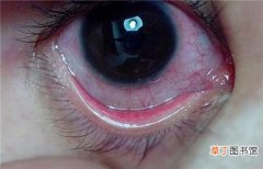 眼睛布满血丝怎么回事 眼睛红血丝形成的原因