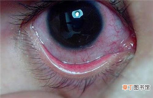 眼睛布满血丝怎么回事 眼睛红血丝形成的原因