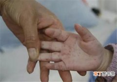 手足口病是怎么引起的 手足口病怎么治疗最好