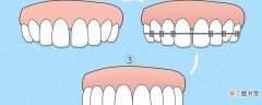 牙线圆线和扁线哪个好用 一根牙线可以清理多少颗牙